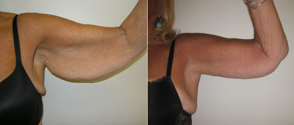 Body Contouring Before & After Photo